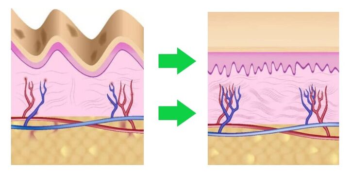 Intencon lines the skin