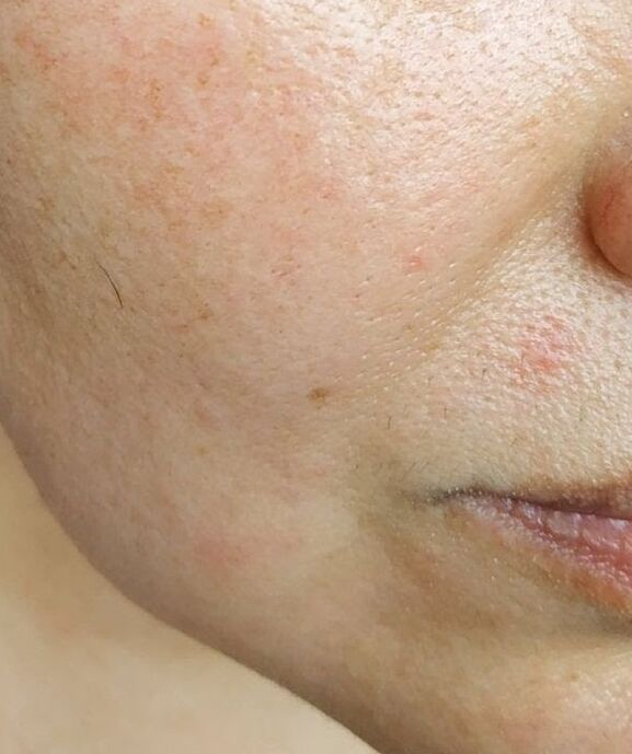 Intencon was rescued by deep nasolabial folds