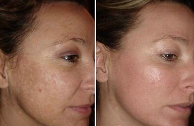 Laser Members on the face before and after photographs
